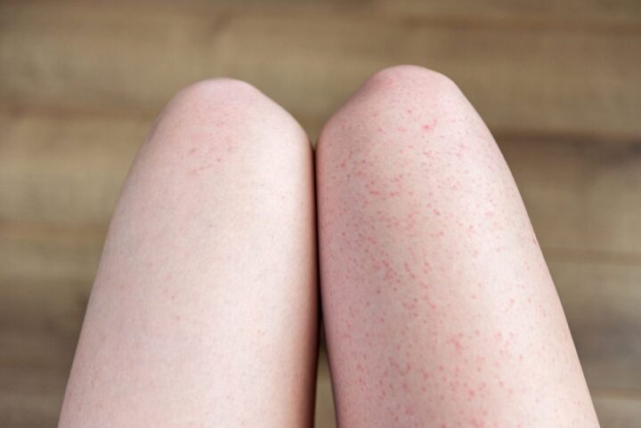 カミソリの自己処理で肌荒れしていませんか？全身脱毛で負担軽減の画像